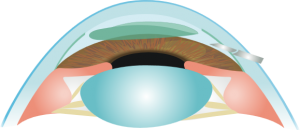 Queratoplastia endotelial
