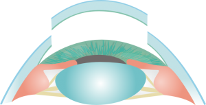 Queratoplastia penetrante