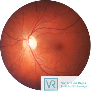 Glaucoma, la ceguera silenciosa | Victoria de Rojas